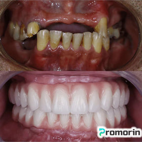 Dentadura de Silicone FIX | Ajustavel e Adaptativa Saúde & Beleza (Dentadura 1) Dm Stores 